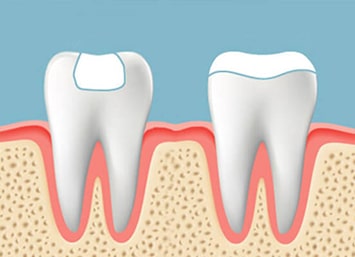dental-inlay