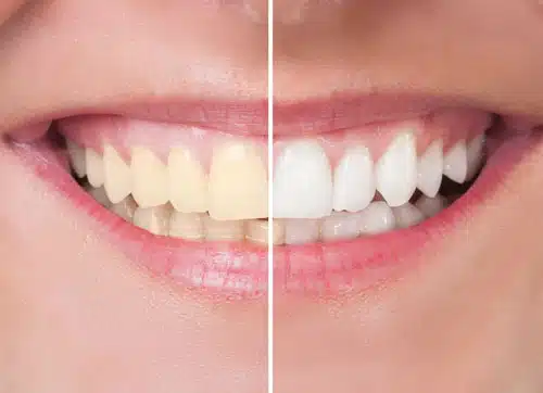 Teeth Whitening before after