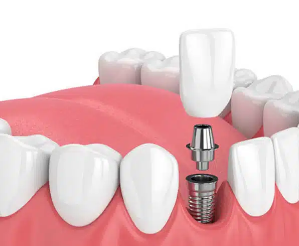 dental implants victorville