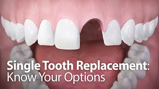 Single Tooth Replacement: Know Your Options