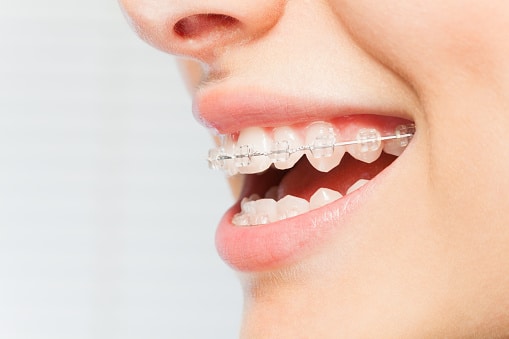 Featured image for “Taking Care of Your Teeth After Adult Braces”