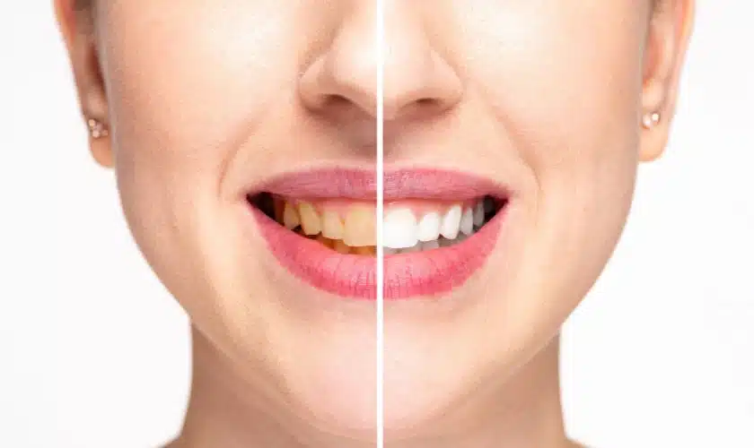 Featured image for “Teeth Whitening for A Special Valentine’s Day: Preparing for a Bright Smile”