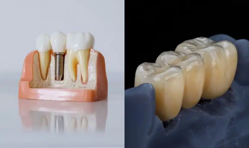 Featured image for “Dental Implant vs Bridges”